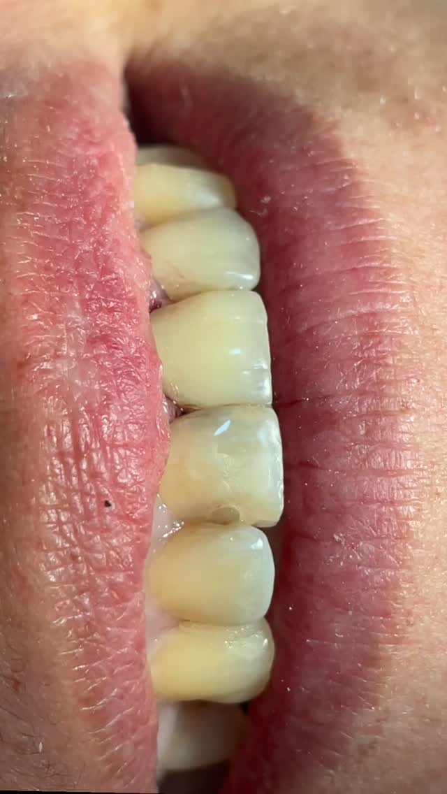 Urgência de hoje 🦷

Dra Roberta Fidelis 
Travessa Neco camando lj 1 
Paracuru

 #odontologia #paracuru #valedocuru 
#dentista #implantes